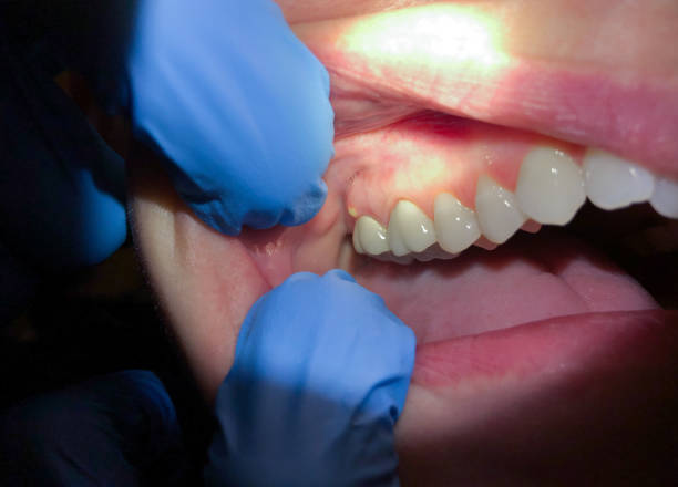 Best Emergency Broken Tooth Repair in Ridgeland, MS